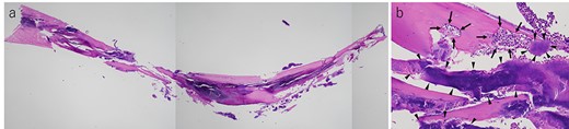 (a) Histological finding on hematoxylin–eosin staining of the lamellar bone extracted from the tumor and (b) cavity erosion, in which inflammatory cells(arrow) and bacteria (arrow head), were observed (a ×2, b ×20).