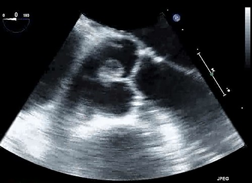 Papillary fibroelastoma seen on trans-esophageal echocardiogram as a pedunculated mass on the aortic valve measuring 16 × 8 mm.