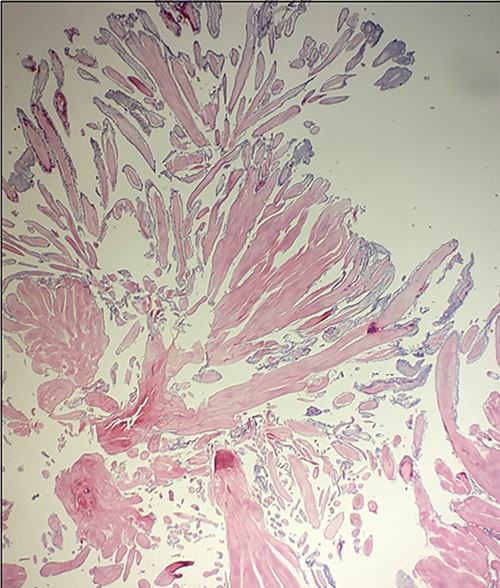 Microscopic appearance of the excised papillary fibroelastoma demonstrating avascular branches lined by endothelial cells.