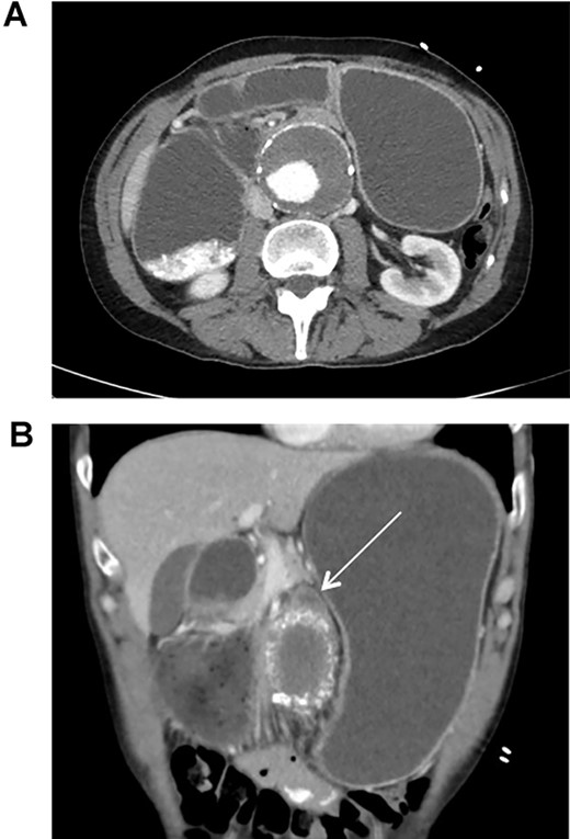 CT scan illustrating duodenal obstruction secondary to external compression of abdominal aortic aneurysm (A); CT scan illustrating transition point of obstructed duodenum as it traverses the abdominal aortic aneurysm (B, arrow).