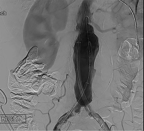 Intraoperative fluoroscopy illustrating infra-renal, abdominal aortic aneurysm prior to graft placement.