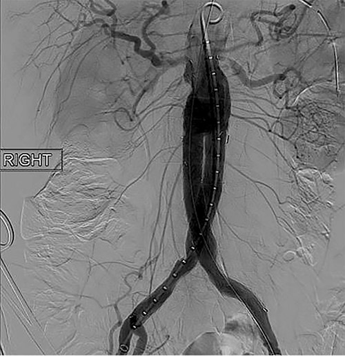 Intraoperative fluoroscopy illustrating successful endovascular aneurysm repair (EVAR).