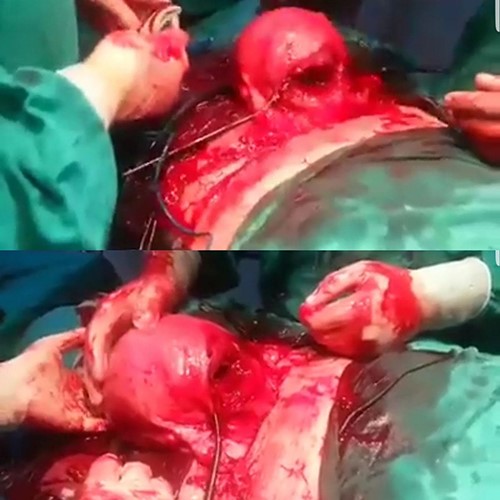 Exteriorizing the uterus intraoperatively to correct its position by rotating it 180° around its longitudinal axis. The arrow illustrates the posterior low transverse uterine incision.