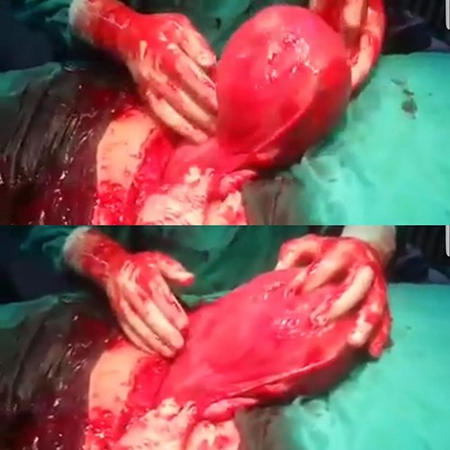 The anterior surface of the uterus obviously showing no incisions.