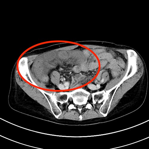 Contrast-enhanced abdominal computed tomography findings. Small bowel loops with caliber change and edematous mesentery are in the right lower abdomen.