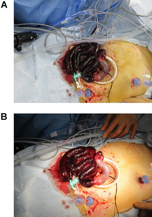 Intraoperative photographs of the bowel after small laparotomy. (A) Without a shadowless lamp, the involved bowel was black/purple in colour. (B) Under a shadowless lamp, the affected bowel appeared reddish.