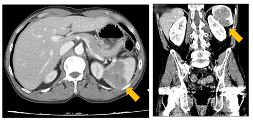 CT image showing a lobulated, less-enhanced mass measuring 5.8 × 5.3 cm in the patient’s spleen, prompting the suspicion of splenic metastasis.