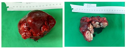 Specimen measuring 9.0 × 6.0 × 4.5 cm3 (spleen) with two encapsulated tumours.
