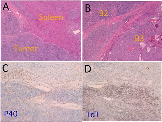 (A) Tumour (lower left) and spleen tissue (upper right). (B) Type B2 thymoma (upper left) and type B3 thymoma (lower right). (C) Positive staining P40. (D) Positive staining for TdT.