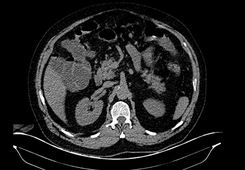 Distention of some loops of the small intestine.