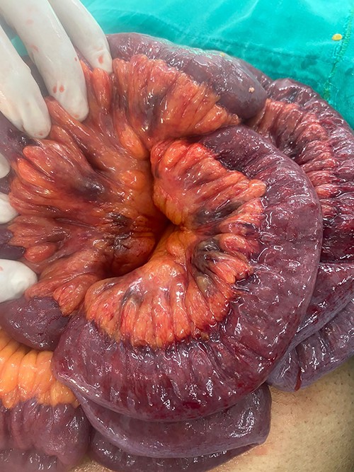 Small bowel with a purplish color with areas of edema in the mesentery and hematomas.
