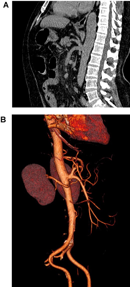 (A). Abdominal CT, showing the celiacomesenteric trunk. (B). Abdominal 3D reconstruction, revealing the vascular variation.