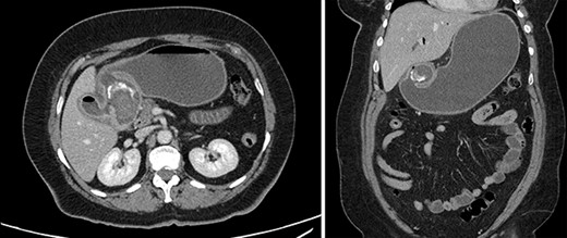 Contrast-enhanced computed tomography (CT). Axial and coronal views of a 2.6 cm stone in the proximal duodenum, gallbladder wall thickening, fat stranding in the porta hepatis and pneumobilia in the non-operative patient.