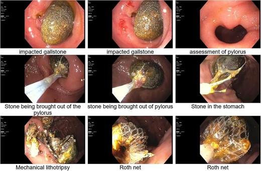 Esophagogastroduodenoscopy (EGD); identification, retrieval and mechanical lithotripsy of a 2 × 3 cm gallstone impacted in the duodenal angle.