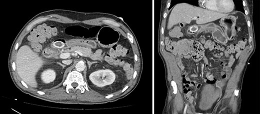 Contrast-enhanced CT. Axial and coronal views of a 4 cm stone in the duodenal bulb, gastric dilation, and pneumobilia in the operative patient.
