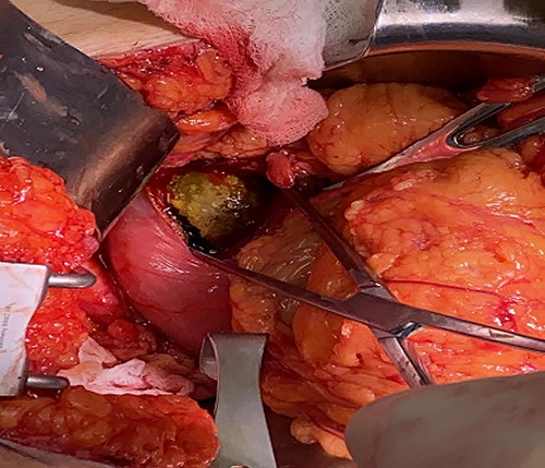 Intraoperative photo; 6 cm × 3 cm gallstone lodged in the duodenal bulb.