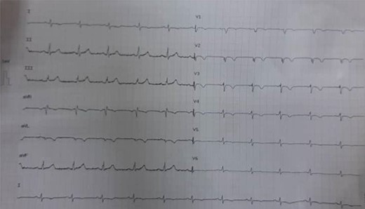 ECG shows low voltage.
