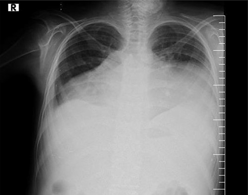 Chest X-rays show an enlarged cardiothoracic ratio, a lack of cardiac silhouette and pleural effusion.
