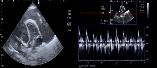 Massive precardial effusion with a swimming heart (A); respiratory variability at the mitral inflow level (B).
