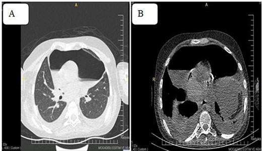 Pneumoprecadium on chest CT (A) and moderate pleural effusion (B).