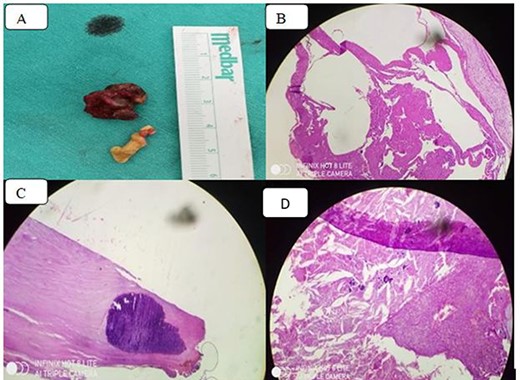 (A) Thickened pericardiumbiopsy; (B) chronic inflammation with granuloma formation on a fibrinous background (Hematoxylin and eosin stain); (C) diffuse calcification in the pericardium and (D) dystrophic calcification, macrophages, cholesterol clefts and chronic inflammation.