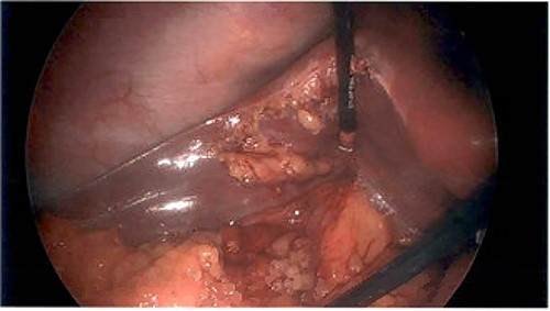 Image showing the absence of a gallbladder within the fossa of the liver.