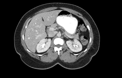 CT scan of the abdomen showing the absence of the gallbladder within the gallbladder fossa. This image also depicts the absence of malrotation of the gut or horseshoe kidney.