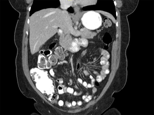 CT scan of the abdomen showing the absence of the gallbladder within the gallbladder fossa. This image also depicts the absence of malrotation of the gut or horseshoe kidney.