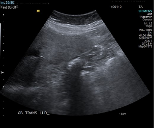 Ultrasound of the gallbladder showing echogenic shadow from the gallbladder fossa around gallstones, suggesting a collapsed gallbladder around stones.
