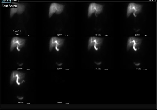 HIDA scan showing normal extraction of radiotracer into the biliary tree with non-visualization of the gallbladder, pre morphine.