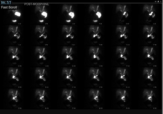 HIDA scan showing normal extraction of radiotracer into the biliary tree with non-visualization of the gallbladder, post morphine.