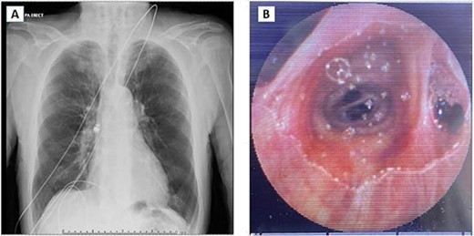 (A) Chest X-ray showing capsule in the right main bronchus. (B) Capsule lodged in bronchus intermedius showing endobronchial anatomy.