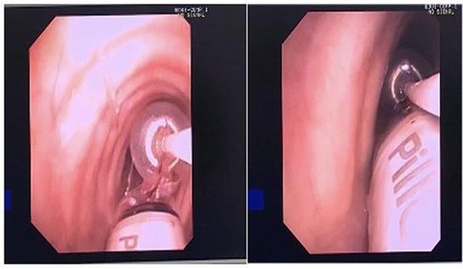 Fogarty balloon Catheter showing removal of Pill Cam.