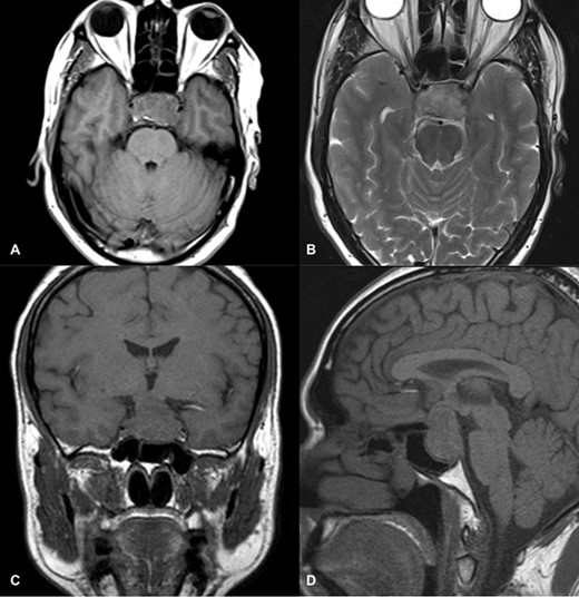 MRI images of axial T1 (A), axial T2 (B), coronal T1 (C), and sagittal T1-weighted images (D) showing a 3 cm × 2.9 cm × 1.8 cm sized suprasellar lesion displacing optic chiasma superiorly and laterally causing a mass effect on bilateral cavernous sinuses (Left>Right) with patchy areas of high signal on T1-weighted images and signal void on T2-weighted images suggestive of hemorrhage.