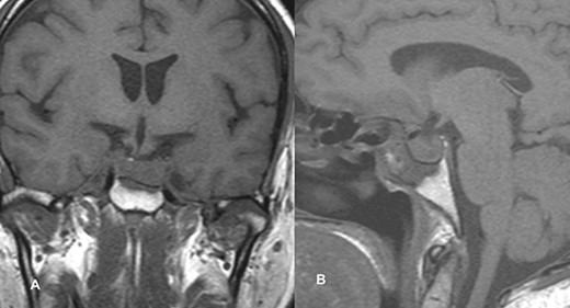 Follow-up MRI imaging of case 1 showed the sellar, suprasellar residual lesion measuring 1.9 × 1.5 × 1.1 cm without a significant mass effect on cavernous sinus.