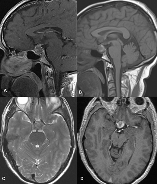 MRI images of post-contrast sagittal T1 (A), sagittal T1 (B), axial T2 (C), and post-contrast axial T1-weighted images (D) showing a 2 cm × 1.6 cm × 1.6 cm sized sellar lesion arising from the pituitary fossa extending superiorly in the suprasellar region and laterally causing a mass effect on the left cavernous sinus with intrinsic high T1 signal in the periphery and signal void on T2-weighted images suggestive of hemorrhage.