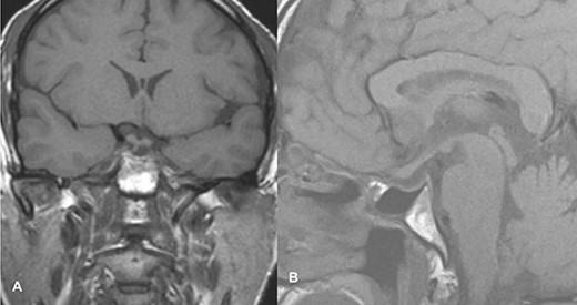 Follow-up imaging of case 2 showed no evidence of a residual lesion in sella turcica.