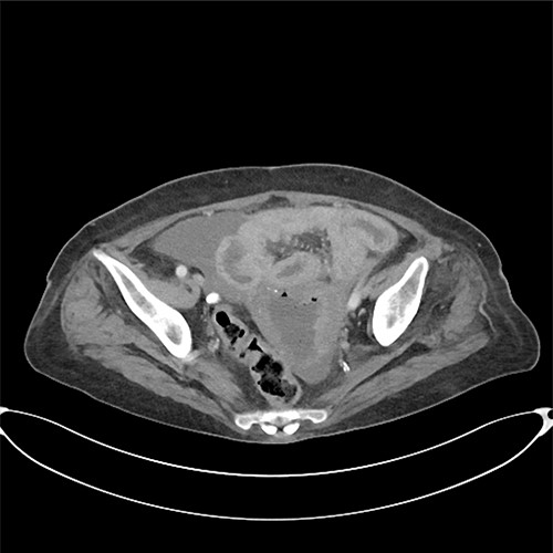 Pyometra with moderate ascites.