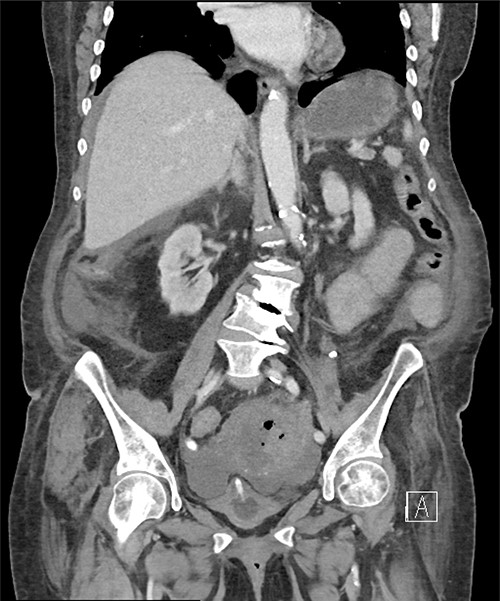 Pneumoperitoneum demonstrated in the perihepatic and perigastric regions.