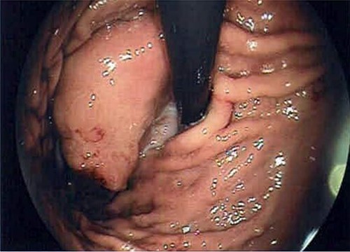 Endoscopy image that reveals the presence of the GIST in subcardial position.