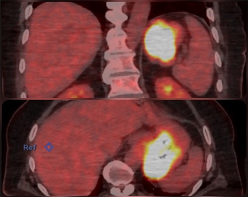 PET-CT image who shows the localisation of the GIST.