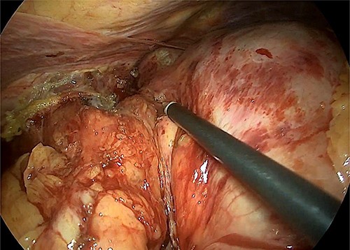 Intraoperative image that reveals the hiatal dissection and the proximity of the tumour with the cardia.