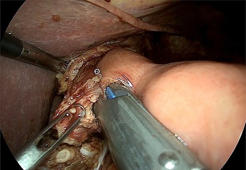 Intraoperative image that reveals the confection of oeso-jejunal anastomosis.