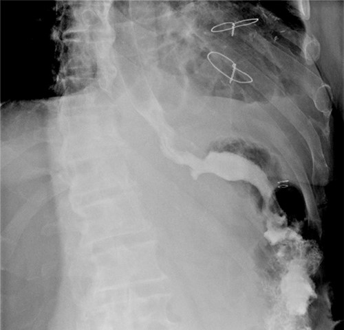 Oeso-jejunal post-operative transit.