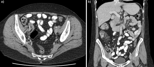 CT abdomen with intravenous and oral contrast demonstrating enlarged appendix, found to be appendiceal endosalpingiosis on histopathology of appendicectomy specimen, in (a) axial section and (b) coronal section. Arrows to enlarged appendix.
