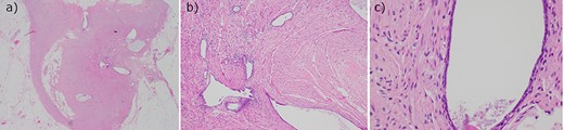 Histopathology of the appendix with hematoxylin and eosin stain demonstrating occasional endometrial type glands with no stroma or hemosiderin macrophages, in keeping with endosalpingiosis. Viewed in (a) low, (b) intermediate and (c) high magnification.