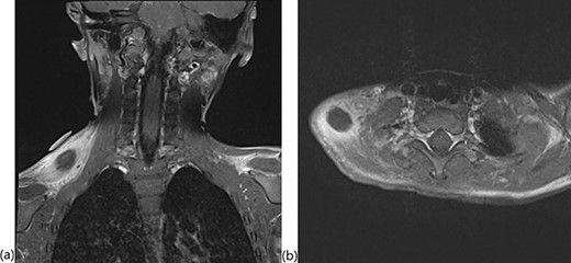 T1-weighted MRI with fat saturation showing the intramuscular mass in the (a) coronal and (b) axial planes.