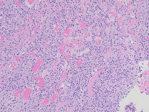 Skeletal muscle with a dense inflammatory infiltrate of predominantly histiocytes and monocytes (H&E, ×20 objective).