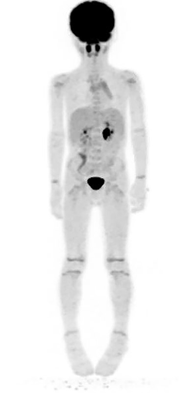 PET scan performed 4 months following surgical removal of the mass showing no abnormal uptake in the right neck/supraclavicular region.