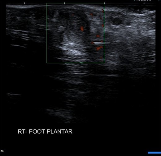 USS right foot plantar showing mass deep to plantar fascia.